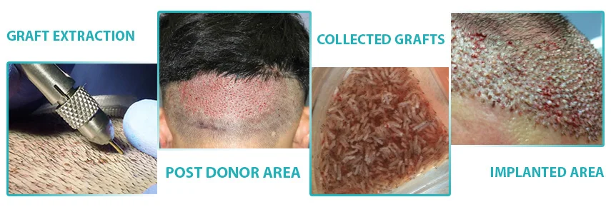 fue hair transplant