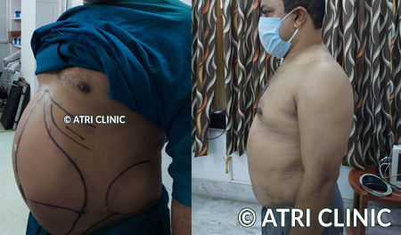 belly fat removal surgery before and after result