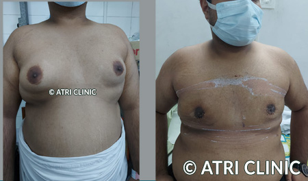 gynecomastia surgery before and after result