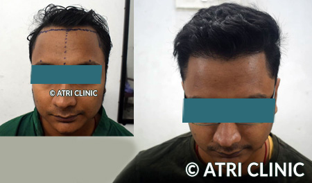 Hair transplant before and after result