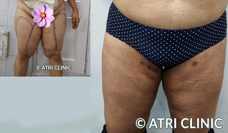 thigh fat removal surgery before and after result